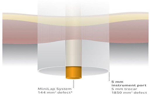 The MiniLap® Percutaneous Surgical System has a calculated defect volume that is more than 12 times smaller than an average 5-mm trocar.