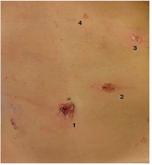 Trocars’ layout in minilaparoscopic cholecystectomy. (1) optic trocar, (2) 10-mm trocar, (3) 5-mm trocar and (4) Minigrip.