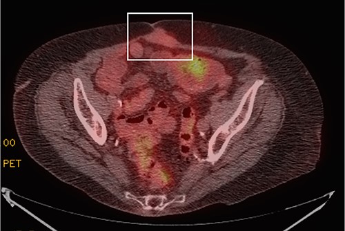 PET scan showing a focal area of mildly FDG avid soft tissue mass within the rectus musculature deep to umbilicus abutting the midline abdominal wall (white box), measuring 3.9 × 2.0 cm, a finding suggestive of a solitary site of metastatic disease. There was no evidence of other sites of metastasis.