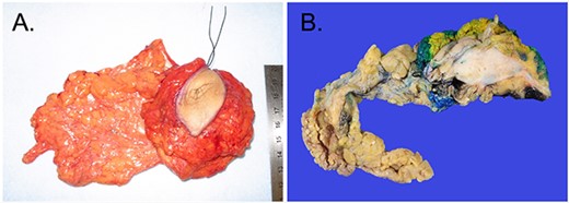 (A) Excised umbilical mass grossly measuring $\sim$8 × 6 × 3 cm in size. (B) Cross-section of the mass which appears as a gray-white, fibrotic and rubbery tumor, directly underlying the skin surface with a portion of omentum adherent to the posterior surface with puckering of the surface. There is no evidence of bowel adherence to the tumor.