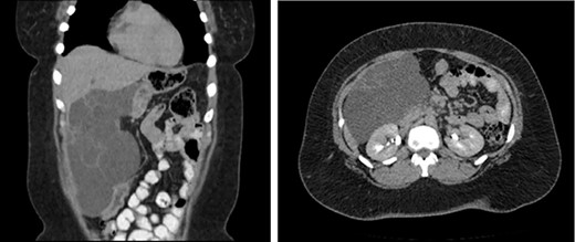 CT of the abdomen and pelvis (coronal, axial) which reveals a septated complex cystic mass displacing the duodenum and vena cava.