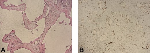 (A) Histopathologic study reveals cystic spaces lined by a single layer of low cuboidal cells (H&E, 10×). (B) The lining cells show positive nuclear staining for WT-1, favoring mesothelial origin.