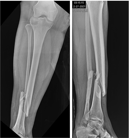 Initial radiographs demonstrating fractures of the proximal fibular neck and distal tibia and fibula.