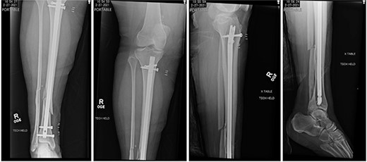 Postoperative radiographs demonstrating reduction of distal tibia/fibula fracture.