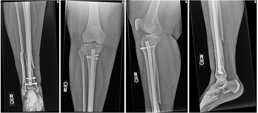 Radiographs at 6 weeks post-op demonstrating unchanged alignment of the distal tibia/fibula fracture.