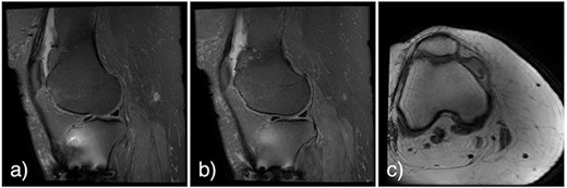 Noncontrast multiplanar T1 (a and b) and T2 (c) MRI at 7 weeks post-op showing a large full-thickness defect on the lateral femoral trochlea measuring 1.8 cm in diameter with a loose chondral fragment in the superior medial joint space.
