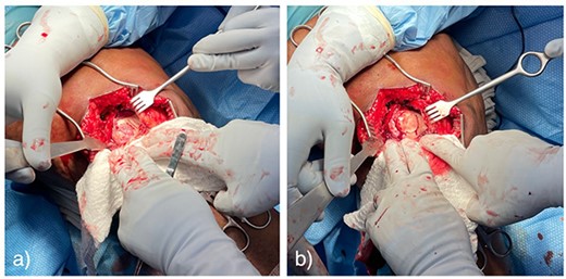 Pictures taken intraoperatively demonstrating full-thickness cartilage defect of the lateral femoral trochlea (a), and press-fit osteochondral allograft repair (b).