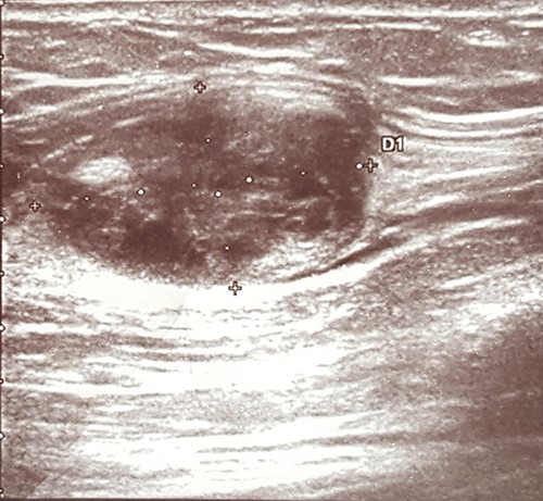 Ultrasound showing a heteroechogenic mass in the left arm.