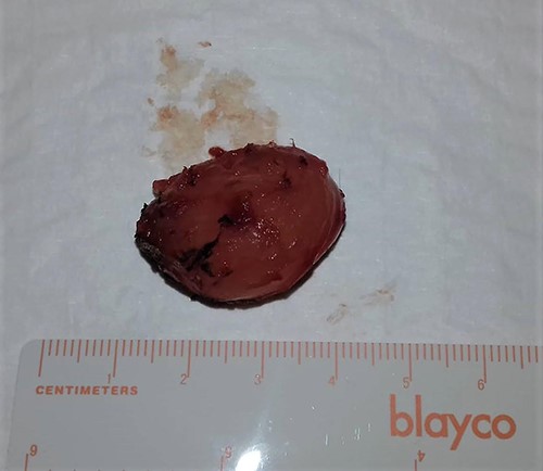 Macroscopic picture of the lesion.