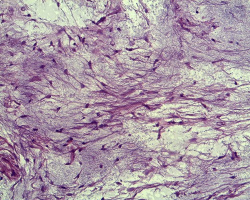 Tumour cells are small, spindle to stellate shaped with a pale indistinct cytoplasm and small hyperchromatic nuclei in which mitoses are rare (hematoxylin and eosin staining, ×20).