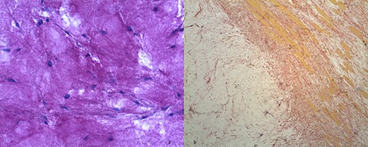 (a) Hypocellular myxoid tissue (periodic acid-Schiff staining, ×20). (b) The tumour contains strands of fibrocollagenous tissue (Van Gieson's staining).