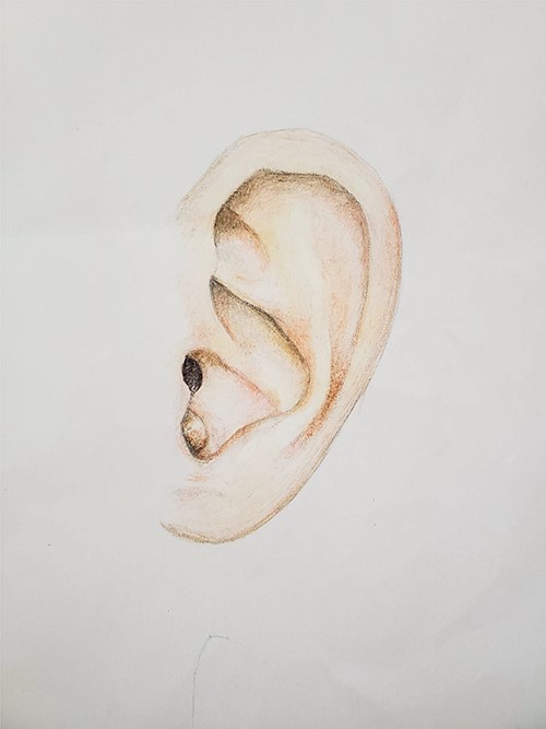 Medical illustration representing the location and macroscopic appearance of the lesion in the left auricle of the 51-year-old patient. Figure courtesy of M. Louka.