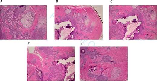 (A–E) Hematoxylin and eosin staining of excisional biopsy revealing trichofolliculoma pathologic characteristics at 200× magnification.