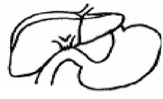 Schematic diagram of hepaticoduodenostomy.