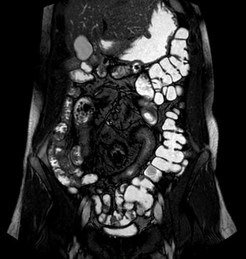 MRI enterography depicting intestinal malrotation and ileal loops in the central abdomen dilated up to 5 cm, consistent with malrotation and a small bowel obstruction.