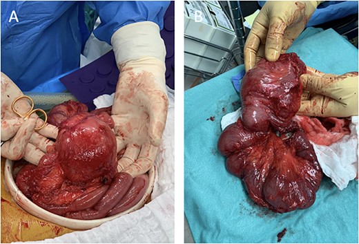 Intraoperative images depicting malrotation of the inflamed intestine (A) and a 35-cm segment of the distal terminal ileum that was resected (B).