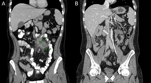 (A) Preoperative image depicting intestinal malrotation and an abdominal abscess measuring 62.5 × 35.3 mm. (B) Postoperative image depicting a Gore-tex graft between the superior mesenteric vein and inferior vena cava.