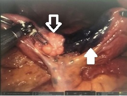 Robotic intraoperative view of identified lesion; the intraabdominal lesion was easily identified (white outlined arrow) immediately adjacent to the previously placed endoscopic tattoo (solid white arrow).