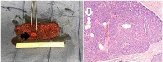 Gross and pathologic representation of resected pancreatic rest; the resected portion of jejunum was opened to reveal an intraluminal mass (solid black arrow); the mass underwent further pathologic evaluation, which revealed acini, ducts (outlined white arrow) and Islet cells (solid white arrow) specific to the pancreas and confirming the diagnosis of pancreatic rest.