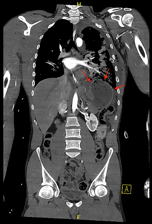 Coronal view of CT chest and abdomen with herniation of the stomach and spleen into the thoracic cavity.