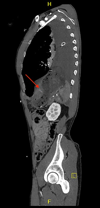 Sagittal view of CT scan demonstrates a level of the left hemidiaphragm.