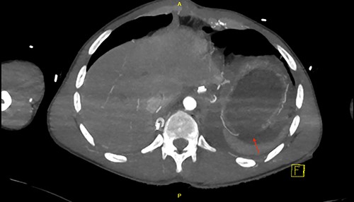 Axial view shows a discontinuity of the gastric wall.