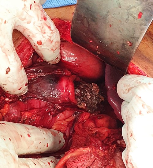 Intraoperative photo after reduction of the ruptured stomach back to the abdominal cavity.