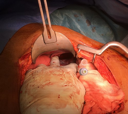 Defect of the left hemidiaphragm.