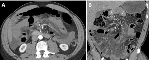 Abdominal and pelvis CT scan showed diffuse infiltration of the mesentery with twisting of the root of the mesentery, including the superior mesenteric artery and the other arterial branches. Additionally, there is moderate diffuse bowel wall thickening with several nonspecific distended small bowel loops. Diffuse inflammatory stranding throughout the mesentery. (A) Axial and (B) coronal views.