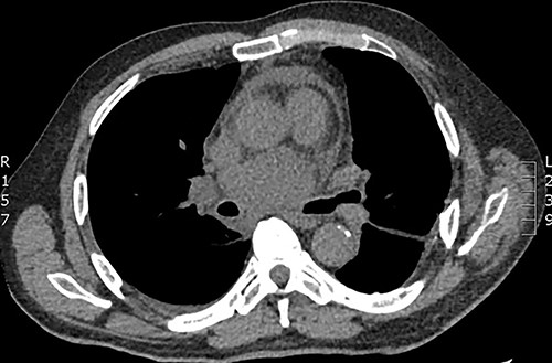 Axial CT demonstrating large subcarinal mass and pericardial effusion.