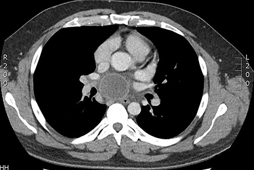 Axial CT scan demonstrating ring enhancing subcarinal mass.