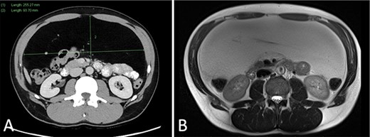 (A) CT portal venous phase axial slice demonstrating a well-circumscribed lipomatous lesion within the greater omentum measuring 9 × 26 × 24 cm; (B) MRI T2-weighted axial slice demonstrating intermediate T2 signal of the lesion.