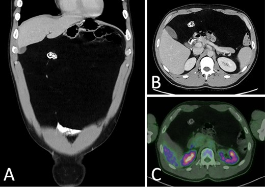 CT portal venous phase (A) coronal slice (B) axial slice demonstrating a focus of coarse calcification and intra-abdominal mass effect; (C) FDG-PET CT axial slice demonstrating a non-metabolically active lesion.