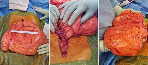 Large lipomatous mass arising from the greater omentum, measuring 7 × 29 × 24 cm and weighing 3.35 kg.