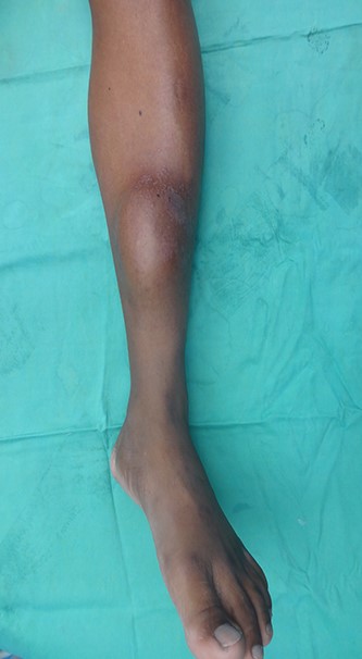 Left leg showing adamantinoma in midtibial region.