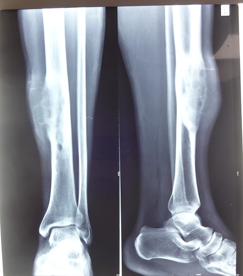 Roentogram suggestive of a lytic expansible lesion in midtibial lesion.