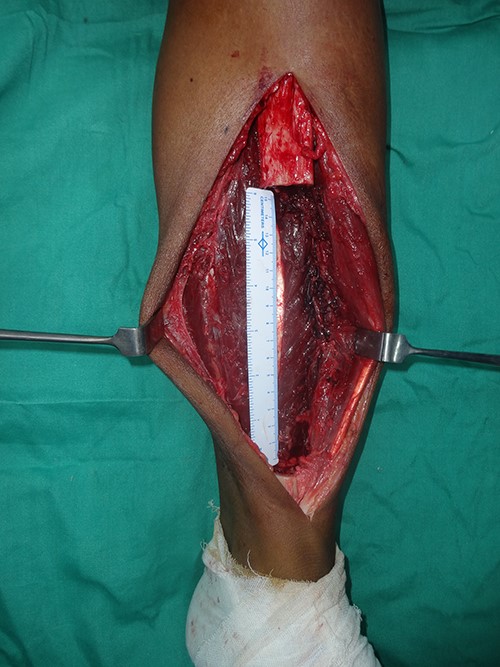 Intraoperative image showing 16-cm bony defect of tibia.