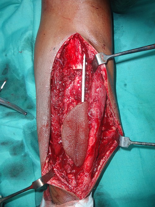 Intraoperative image with bone defect bridged with vascularized free fibula fixed with dynamic compression plate.
