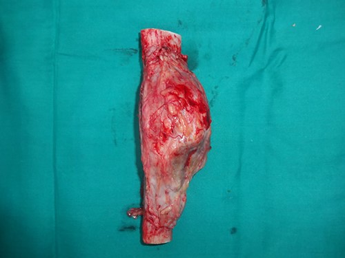Excised tibial segment with adamantinoma.
