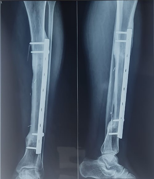 Follow-up X-ray showing bony union at margins of fibula flap.