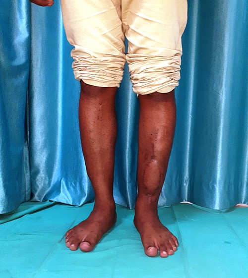 Left leg showing well-set free fibula.