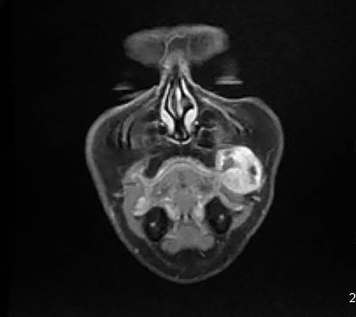 MRI showing the tumor of the left cheek with contrast enhanced.