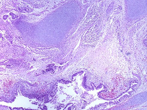 Mature glandular components with cartilage (magnification at ×40).