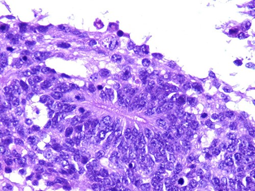 Photomicrograph of primitive neuroectodermal component with neural rosettes (magnification at ×400).