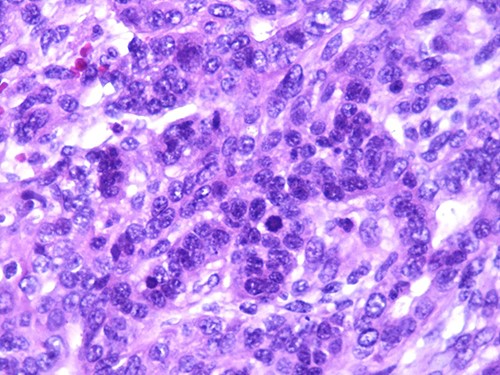 Photomicrograph of carcinomatous component (magnification at ×400).
