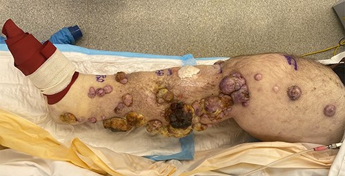 Right leg at commencement of ILI, with foot excluded using an Esmarch bandage.