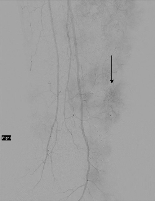 Angiogram of the right leg, showing the significant neoangiogenesis present in the large tumour masses; the arrow indicates one of the highly vascular tumour deposits.