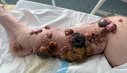 Right leg on Day 9 post-ILI, showing early changes of necrosis particularly in the larger tumour masses.