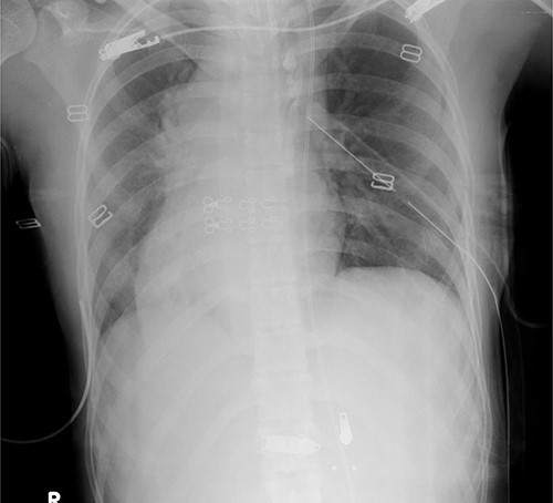 Chest radiograph showing a right-sided heart and widening of the upper mediastinum.