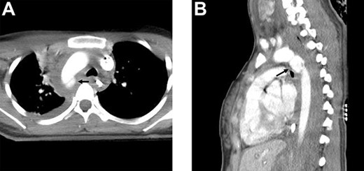 Contrast-enhanced CT scan showing a saccular pseudoaneurysm at the aortic isthmus (arrow) with a mediastinal hematoma; (a) transverse view and (b) lateral view.